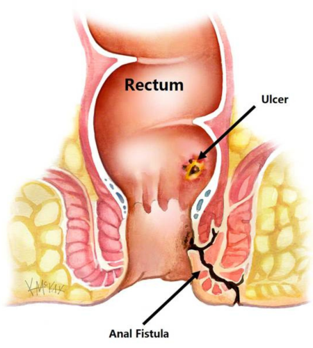Anorectal Surgery