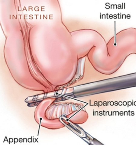 Appendix Surgery