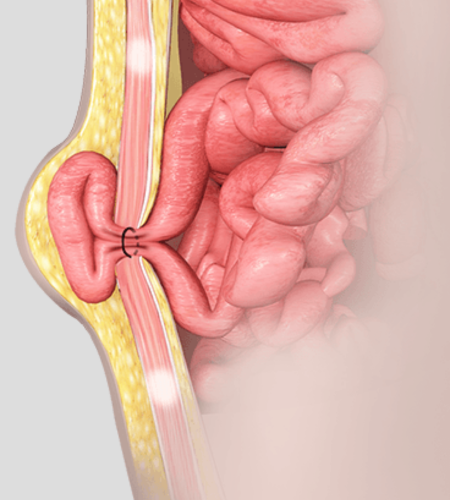 Hernia Surgery